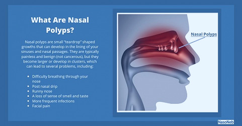Nasal Polyps: Causes, Symptoms, Treatments, and Prevention – NasoNeb®